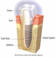implants process